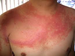 Trattamento di cibo di psoriasi a psoriasi