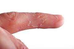 eczema eczema